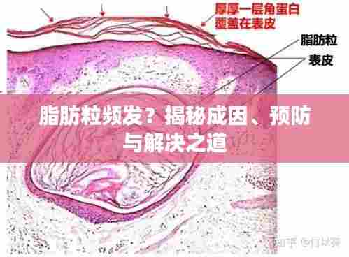 脂肪粒频发？揭秘成因、预防与解决之道