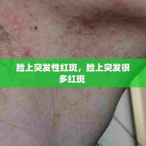 脸上突发性红斑，脸上突发很多红斑 