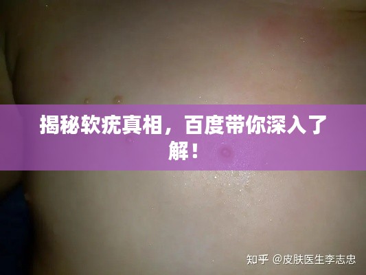 揭秘软疣真相，百度带你深入了解！