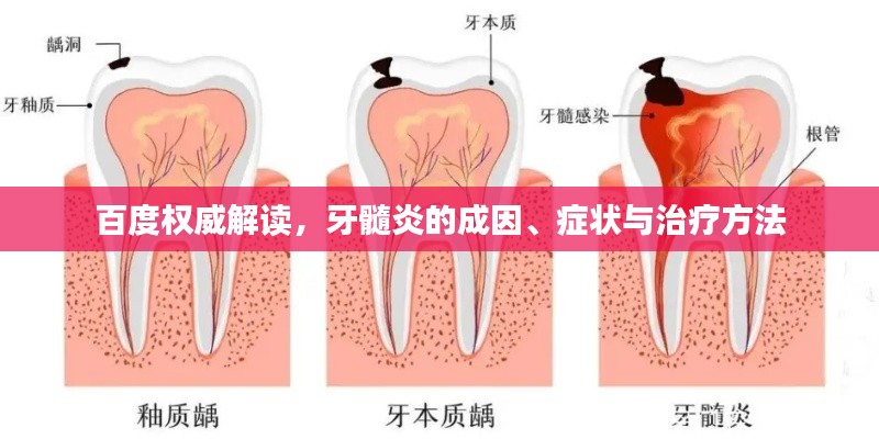 百度权威解读，牙髓炎的成因、症状与治疗方法