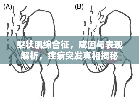 梨状肌综合征，成因与表现解析，疾病突发真相揭秘